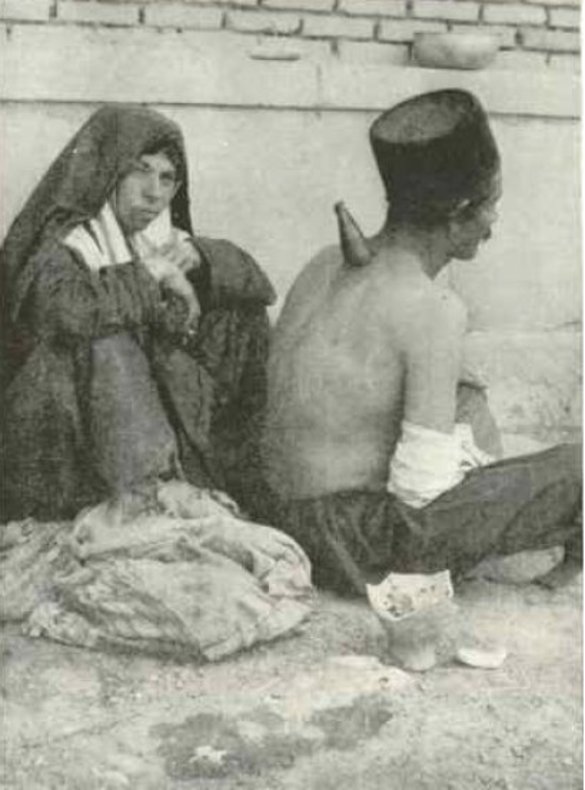 طبیب بادیه‌نشین در حال درمان بیمار با بادکش 