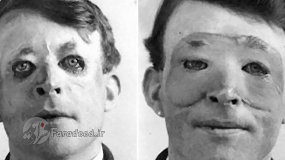 والتر یو سال ۱۹۱۷ اولین عمل جراحی پلاستیک را انجام داد