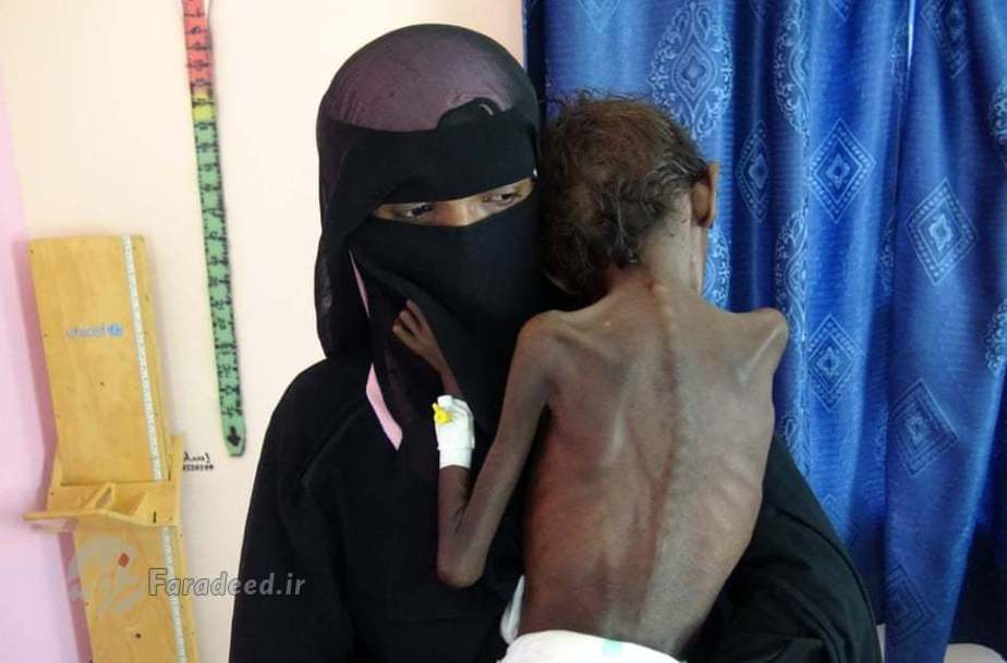 کودکی یمنی که از سوءتغذیه رنج می‌برد در درمانگاه