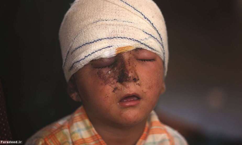 کودک زخمی در جنگ نیروهای عراق و داعش در تلعفر